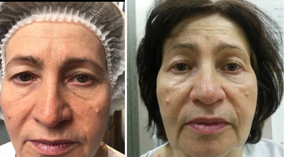 Clinica SANCOS vă prezintă o procedură revoluționară de întinerire: Blefaroplastie fără bisturiu!
