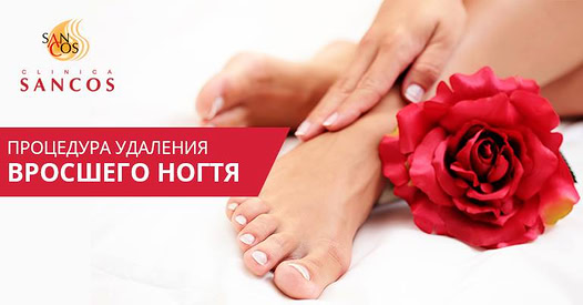 Врастание ногтей больших пальцев ног явление неприятное и доставляет массу неудобств. Заболевание в…