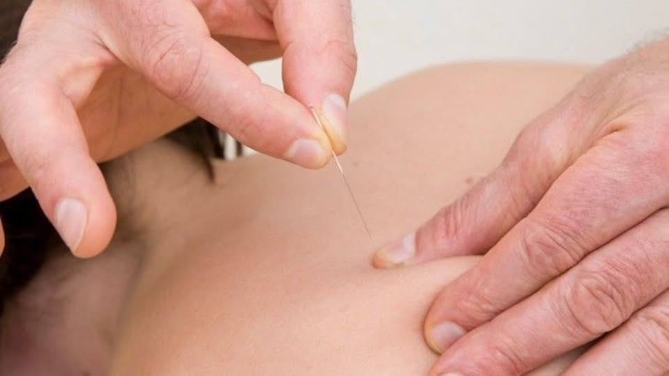 ☯️De ce pacienții noștri apelează la acupunctură?