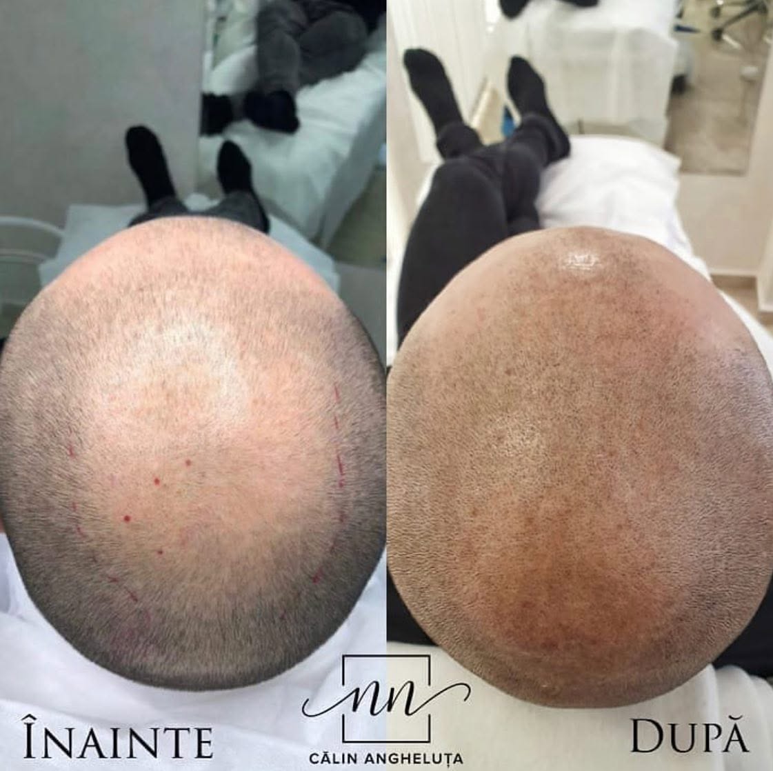 Tricopigmentare - la Sancos utilizăm 2 tehnici distincte, în dependență de necesitatea pacientului.