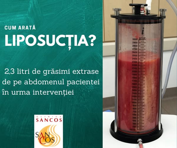 ✅Conform statisticilor mondiale, LIPOSUCȚIA reprezintă cea mai populară intervenție chirurgicală…