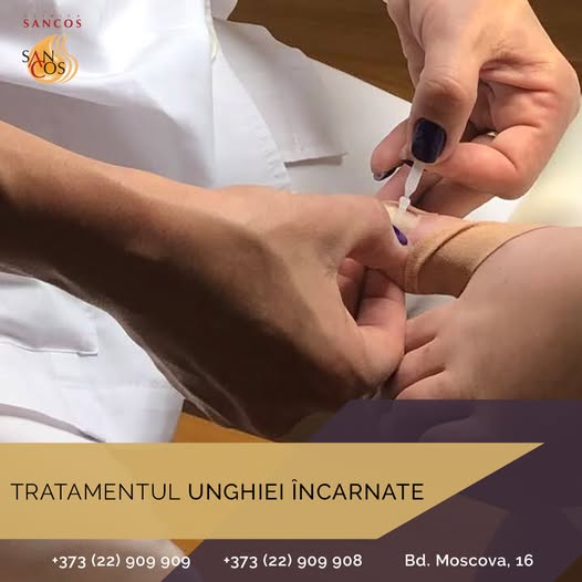 Unghia încarnată sau onicocriptoza, este o inflamație provocată de lovirea sau tăierea incorectă a…