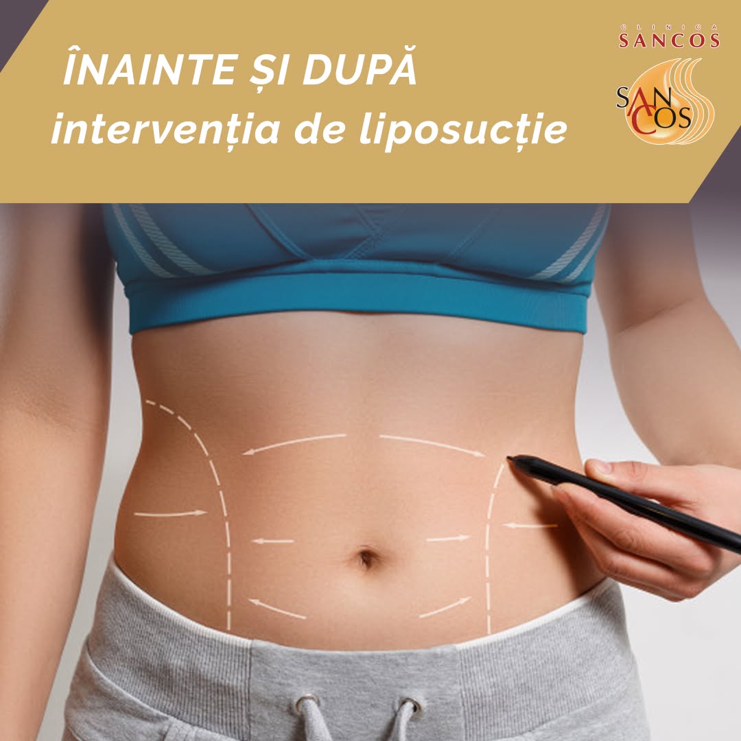 👉Operația de liposucție este o metodă chirurgicală de îndepărtare a grăsimii în exces pe zonele…