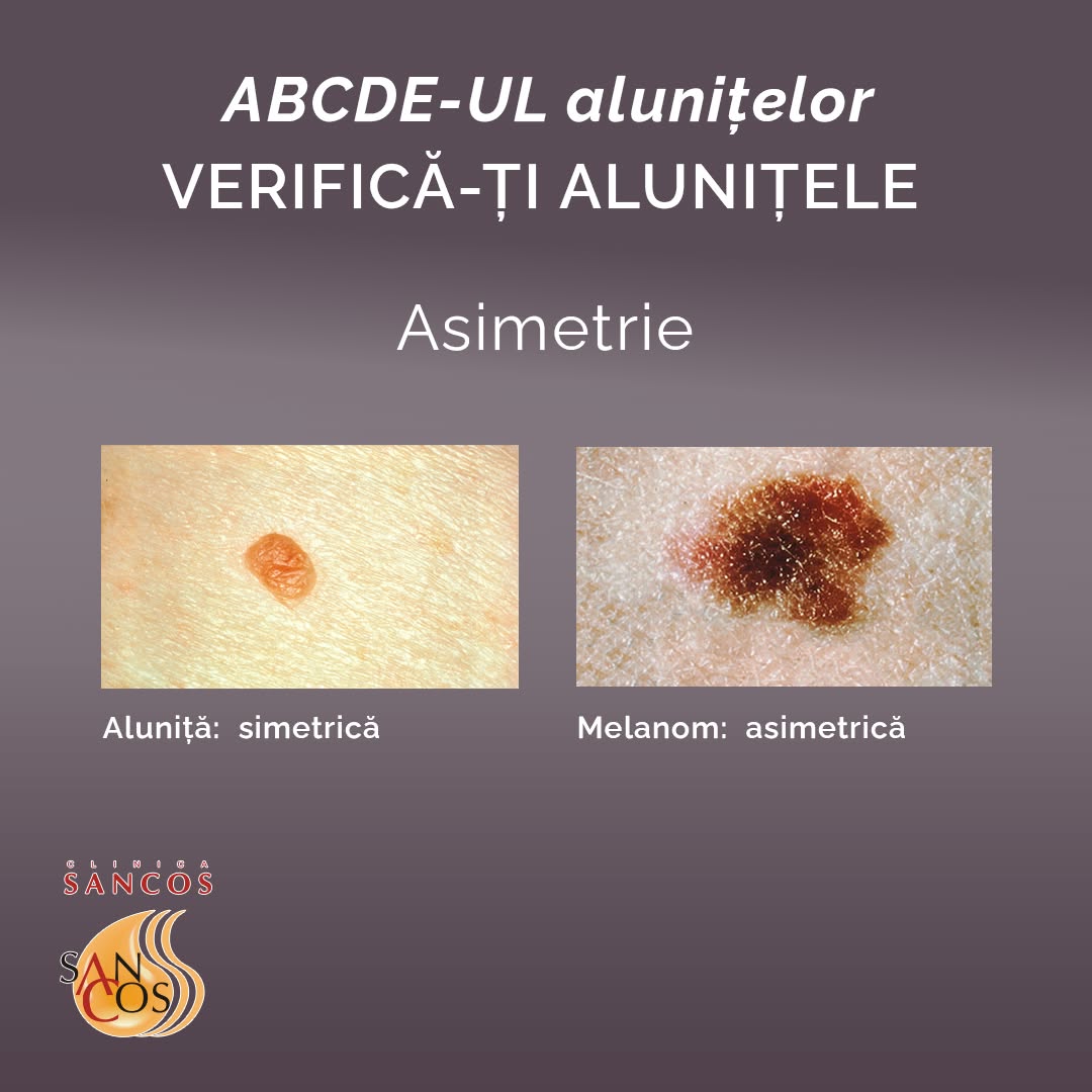 Când ți-ai verificat ultima dată alunițele? 👉Pentru a recunoaște semnele unor nevi periculoși…