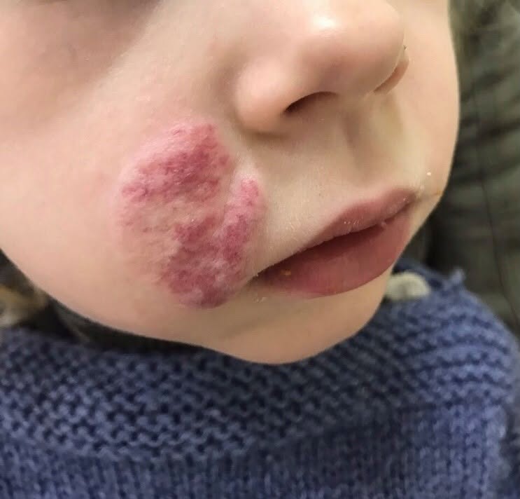 Nadejda a fost diagnosticată cu Hemangiom cavernos.