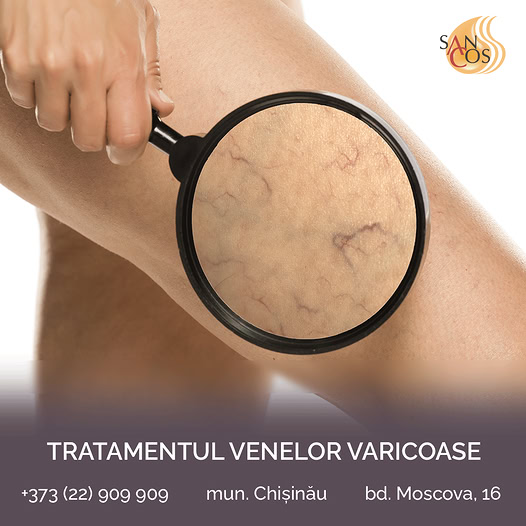 💛 Clinica Sancos vă oferă mai multe moduri de a trata varicele și iată câteva dintre ele: