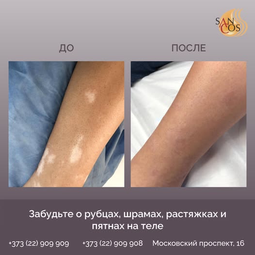 Вы думали, микропигментация - лишь эстетическая процедура? Действительно, с её помощью можно…