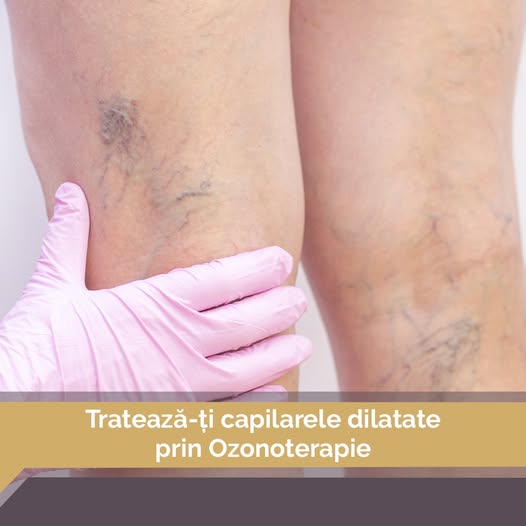 Te-ai săturat de capilarele dilatate la picioare sau pe față? 🤔