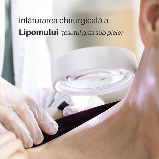 Lipoamele reprezintă tumori inofensive, grase, care se formează sub piele. De obicei sunt…