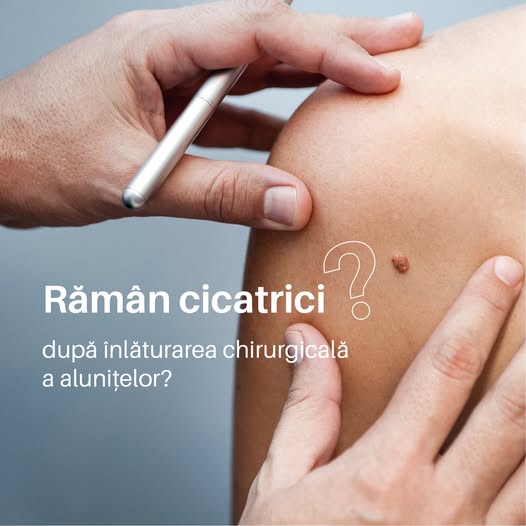 Orice intervenție chirurgicală lasă cicatrici. Totuși, vorbind despre înlăturarea alunițelor, punem…
