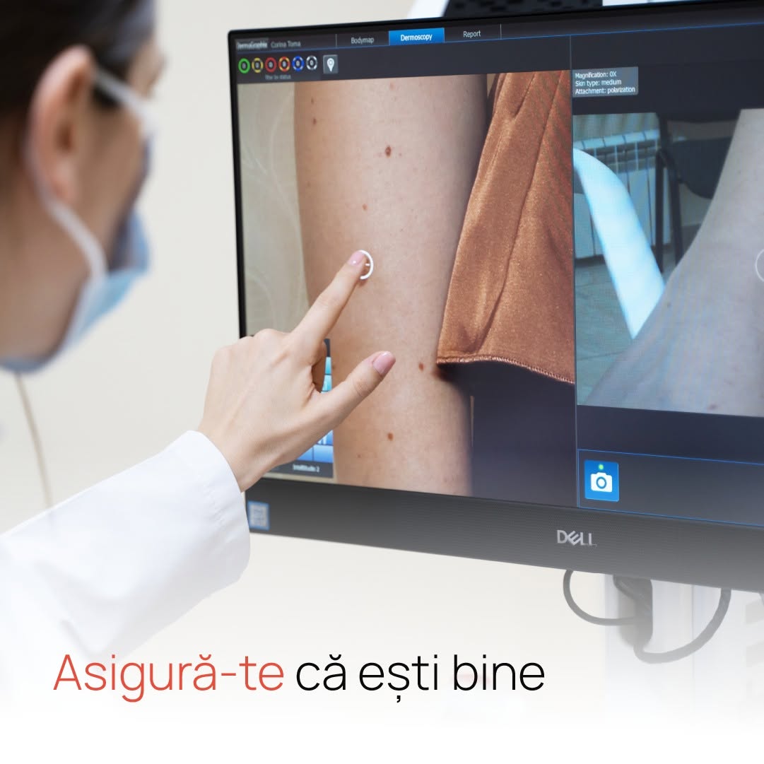 ❗️ Diagnosticul precoce oferă posibilitatea de tratament complet în cazurile cancerului de piele.