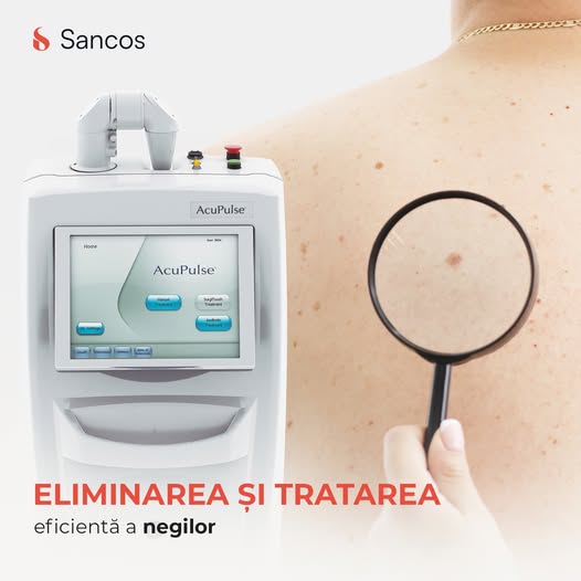 Scapă de negi ușor și rapid cu puterea laserului de ultimă generație!