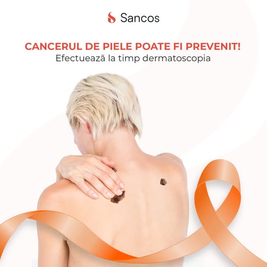 Acțiunile dedicate conștientizării factorilor de risc a melanomului continuă la Clinica Sancos!