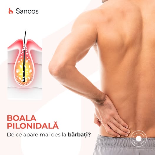 Chistul pilonidal reprezintă o boală inflamatorie a tegumentelor situate deasupra șanțului…