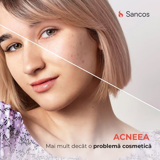 Acneea este încă privită ca o banală afecțiune adolescentină.