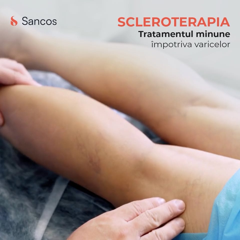 Scleroterapia este una dintre cele mai căutate intervenții din ultima perioadă. Aceasta este o…