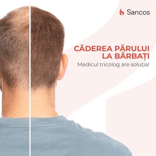 Căderea părului este o problemă comună în rândul bărbaților. Conform statisticilor, aproximativ 40%…