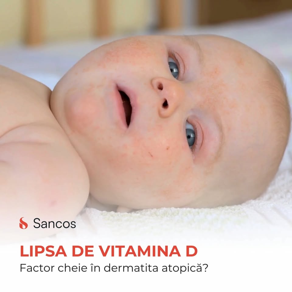 Dermatita atopică afectează aproximativ 30% din populație, fiind mai des întâlnită la copii, în…