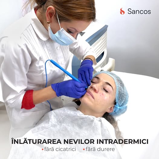 Înlăturarea alunițelor fără cicatrici și fără durere devine o realitate la Clinica Sancos! Fie ca…
