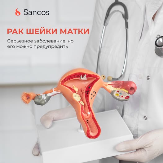 🧏‍♀️Рак шейки матки – серьезное заболевание, но его можно предупредить, если выявляют на начальной…
