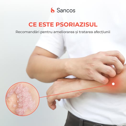 🧏‍♀️Psoriazisul este o afecțiune autoimună cronică ce afectează pielea și se manifestă prin…