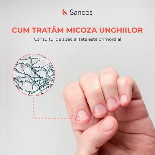 🧏‍♀️Micoza unghiilor – o afecțiune inestetică și dureroasă, dar tratabilă!
