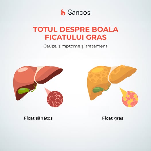 🧏‍♀️Boala ficatului gras, fie că este de tip alcoolic sau non alcoolic, reprezintă o acumulare…