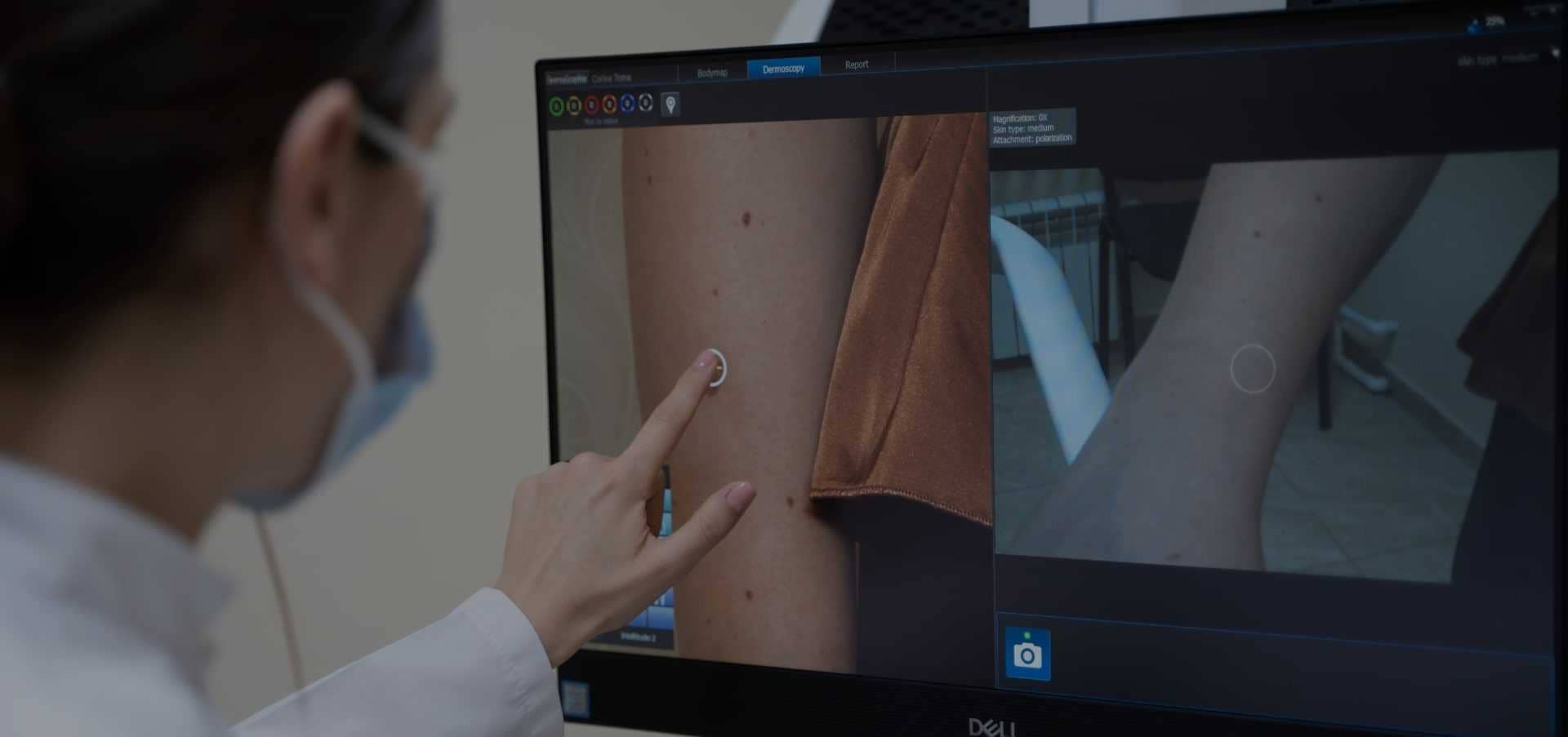 Dermatoscopie computerizată